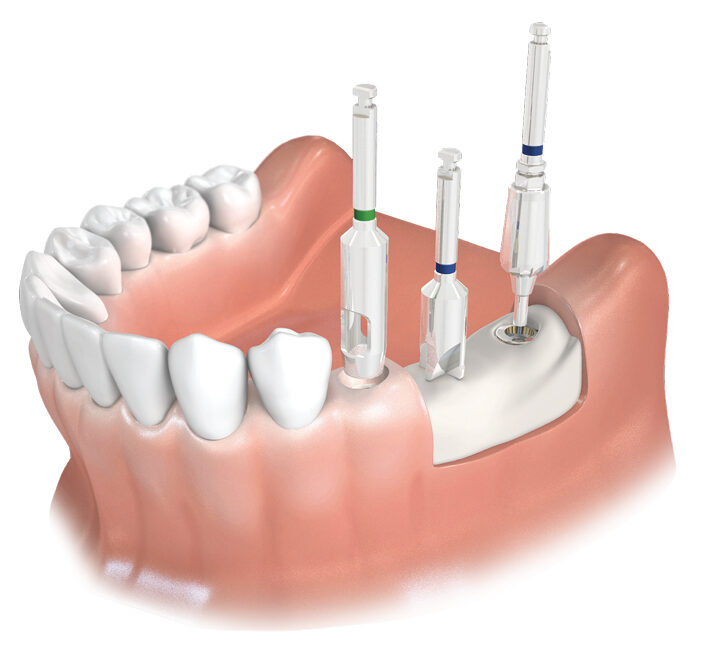 Surgical Accessory Kit